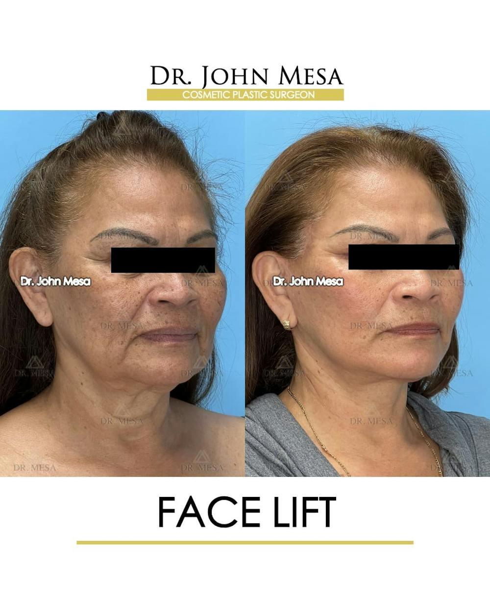 Facelift Before & After Gallery - Patient 218817 - Image 2