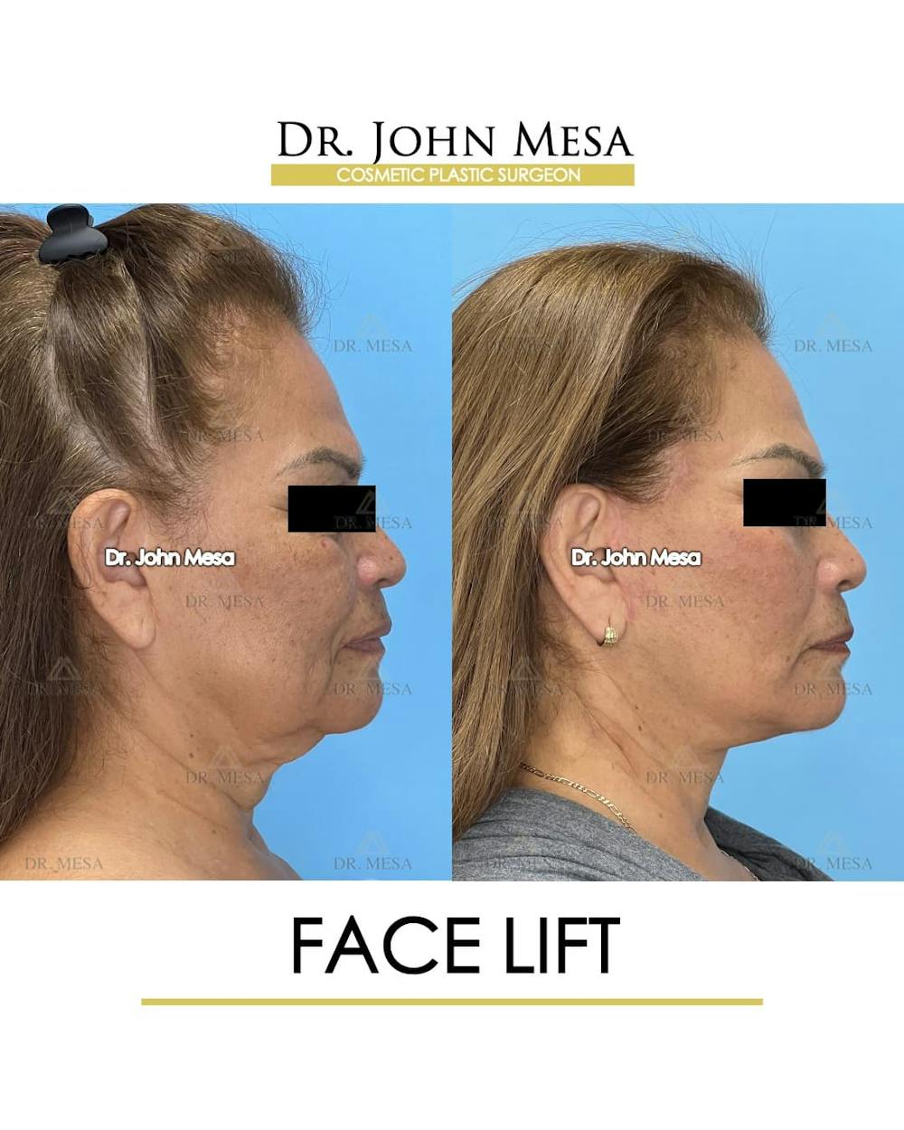 Facelift Before & After Gallery - Patient 218817 - Image 3
