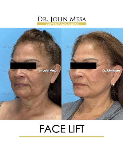 Facelift Before & After Gallery - Patient 218817 - Image 4