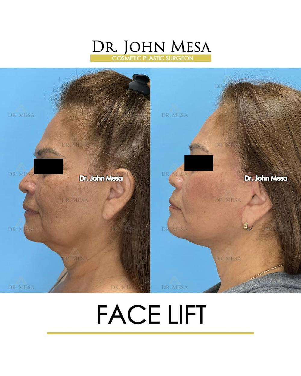Facelift Before & After Gallery - Patient 218817 - Image 5