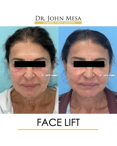 Facelift Before & After Gallery - Patient 314177 - Image 1