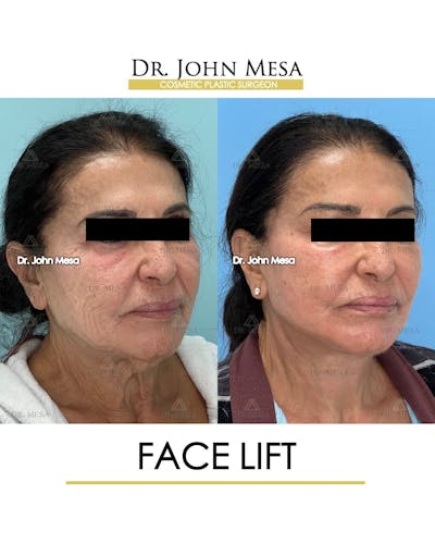 Facelift Before & After Gallery - Patient 314177 - Image 2