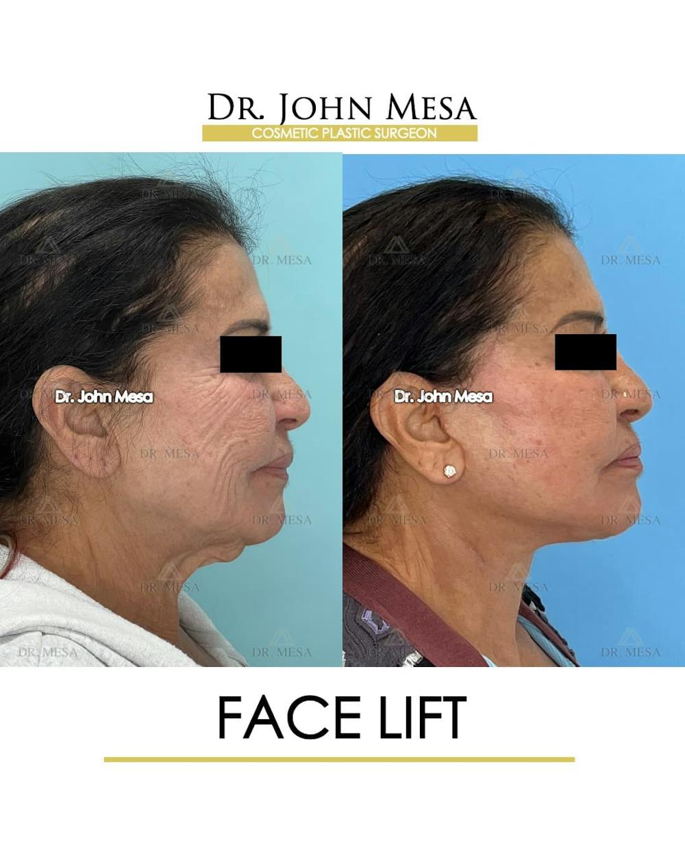 Facelift Before & After Gallery - Patient 314177 - Image 3