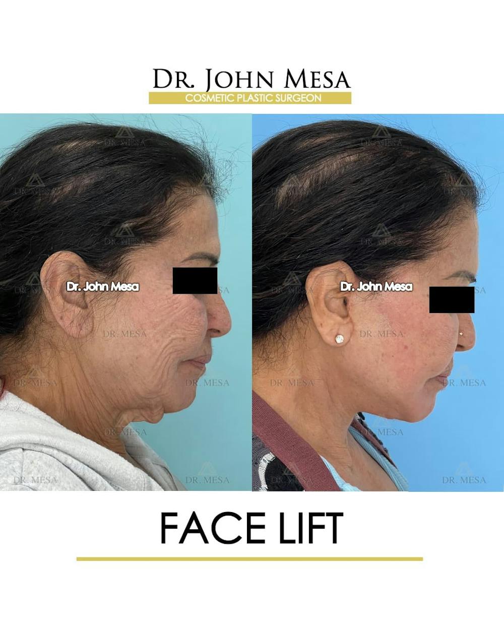 Facelift Before & After Gallery - Patient 314177 - Image 4