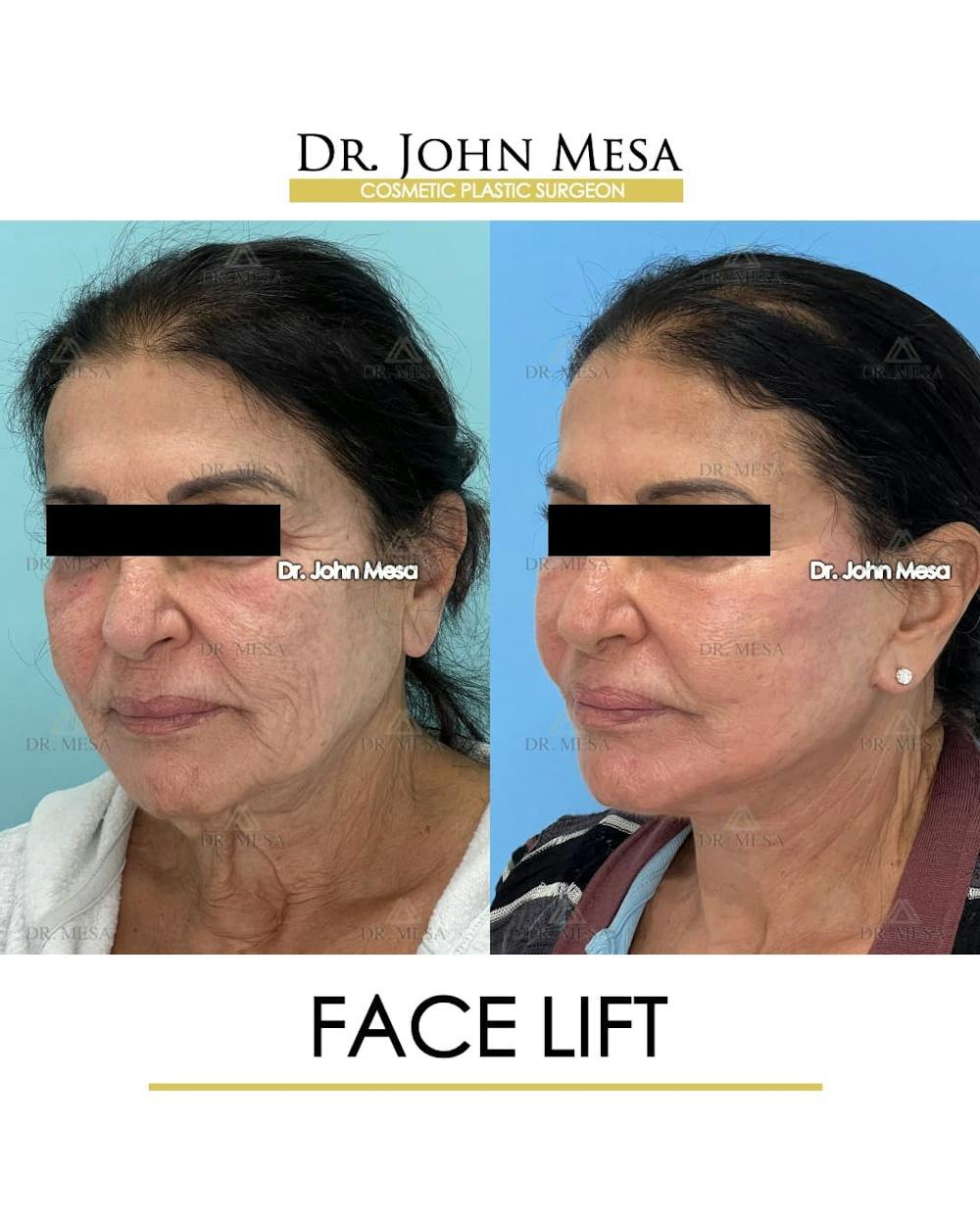 Facelift Before & After Gallery - Patient 314177 - Image 5