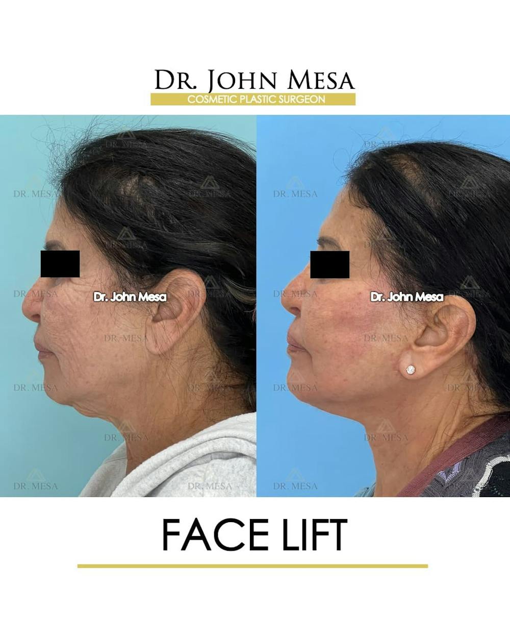 Facelift Before & After Gallery - Patient 314177 - Image 6