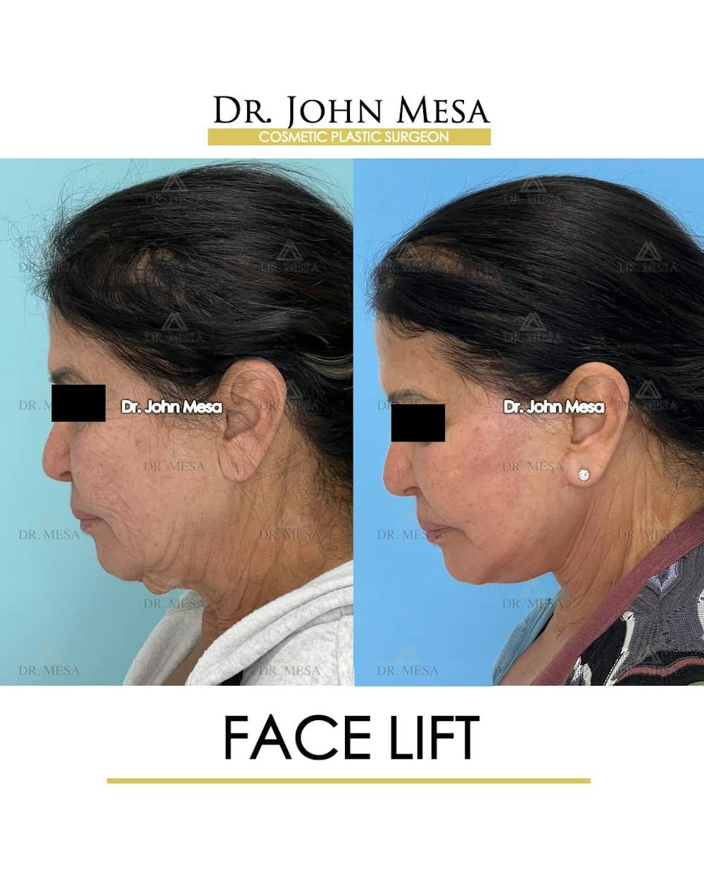 Facelift Before & After Gallery - Patient 314177 - Image 7