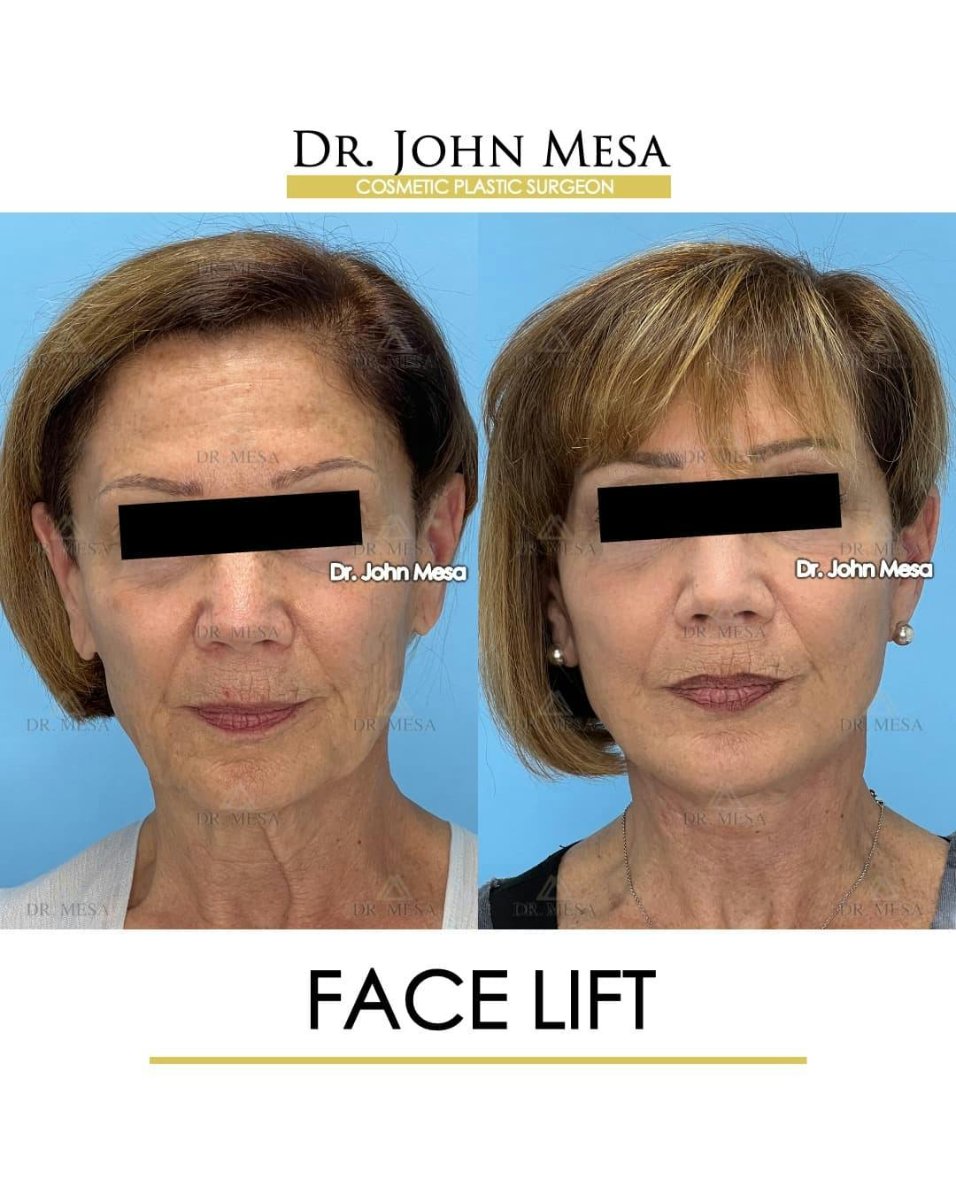 Facelift Before & After Gallery - Patient 325842 - Image 1