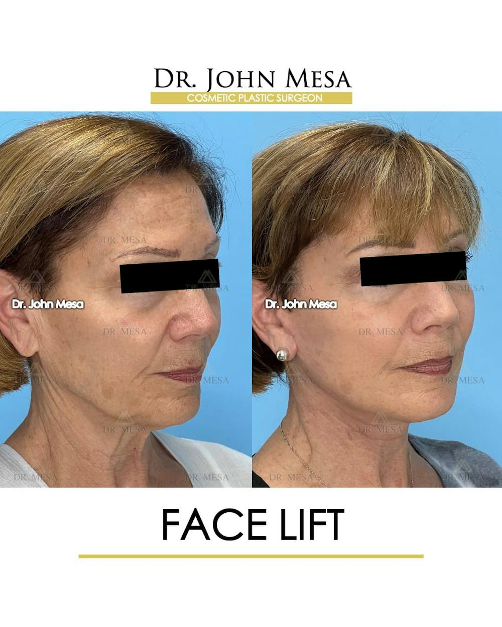Facelift Before & After Gallery - Patient 325842 - Image 2