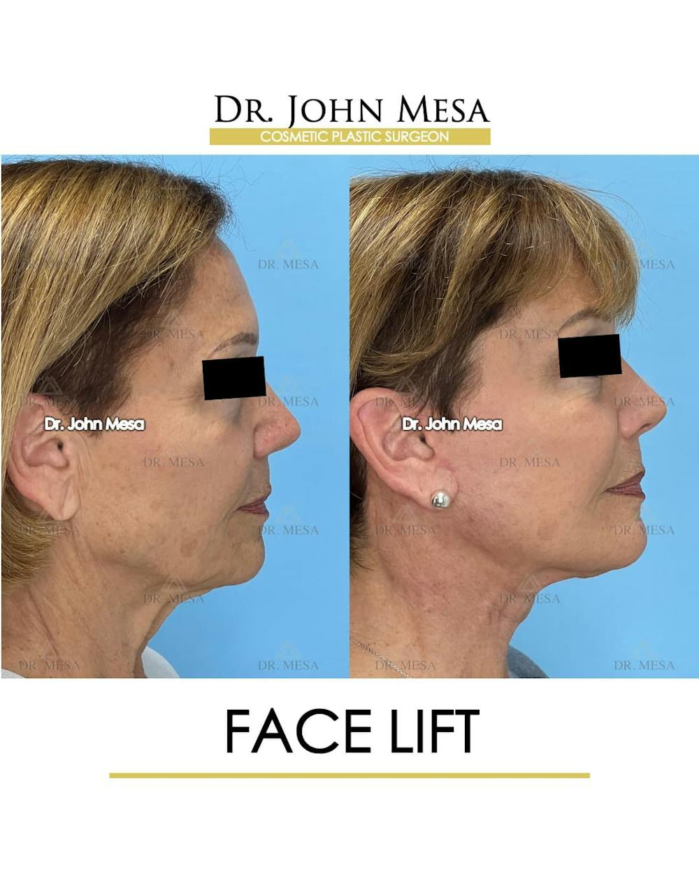Facelift Before & After Gallery - Patient 325842 - Image 3