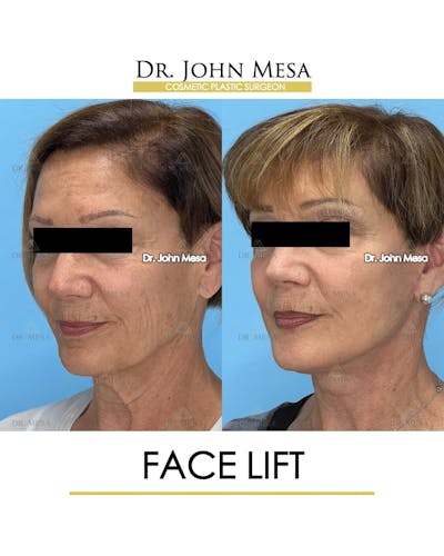 Facelift Before & After Gallery - Patient 325842 - Image 4