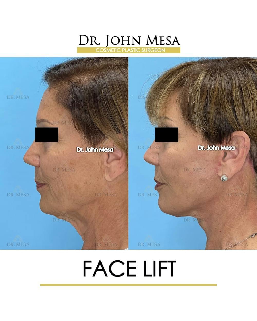 Facelift Before & After Gallery - Patient 325842 - Image 5