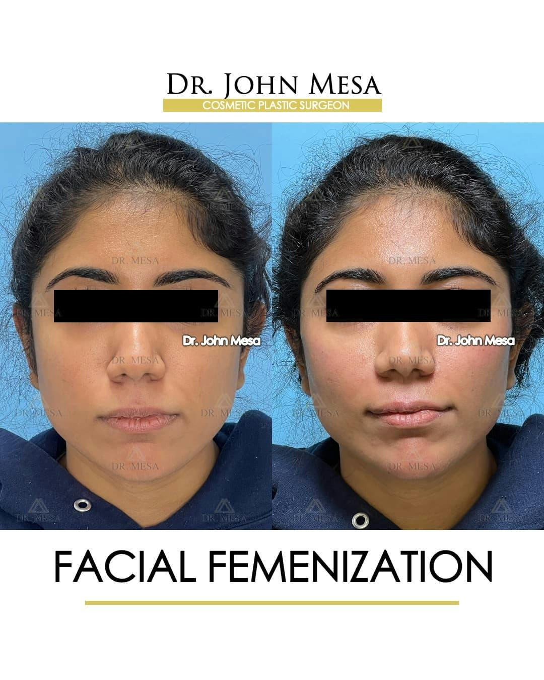 Facial Feminization Before & After Gallery - Patient 842309 - Image 1
