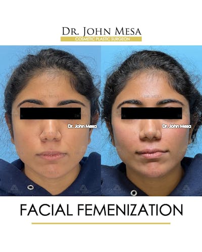 Facial Feminization Before & After Gallery - Patient 842309 - Image 1