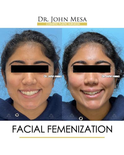 Facial Feminization Before & After Gallery - Patient 842309 - Image 2