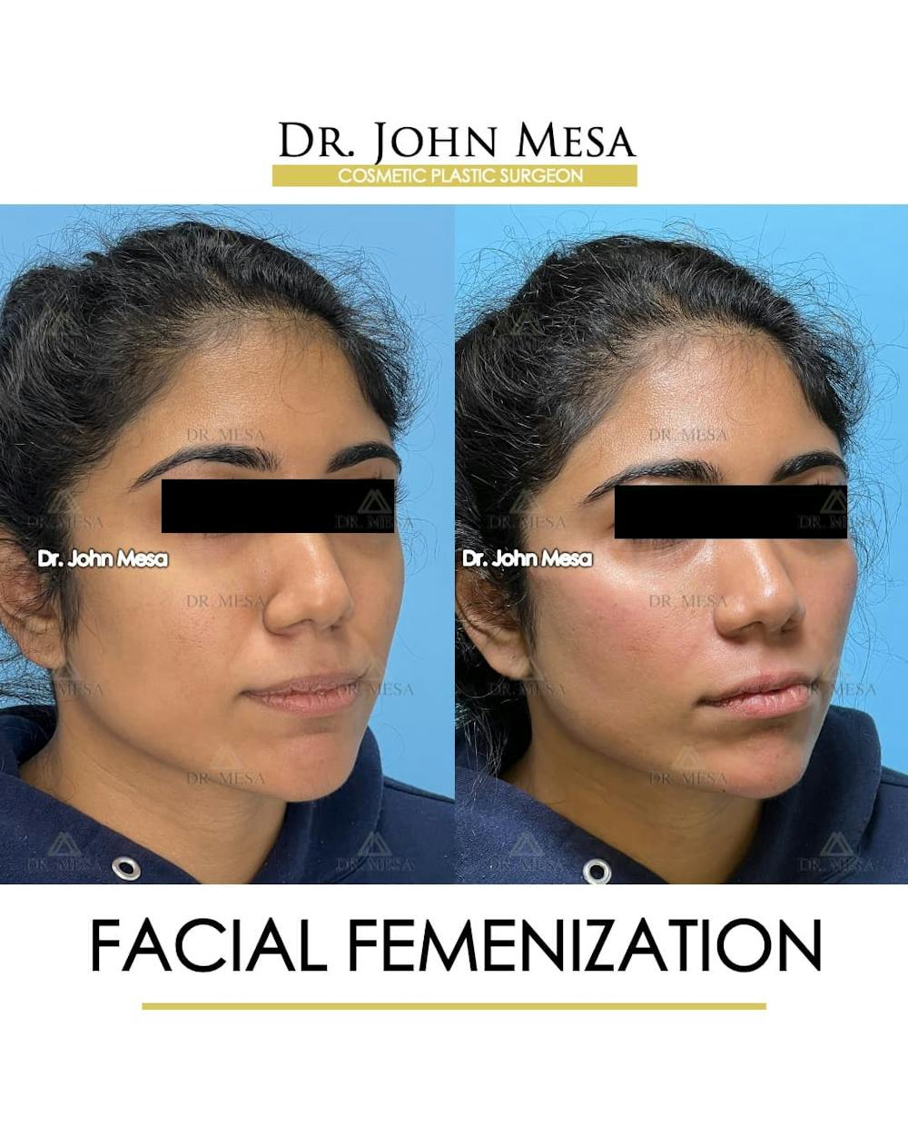 Facial Feminization Before & After Gallery - Patient 842309 - Image 3
