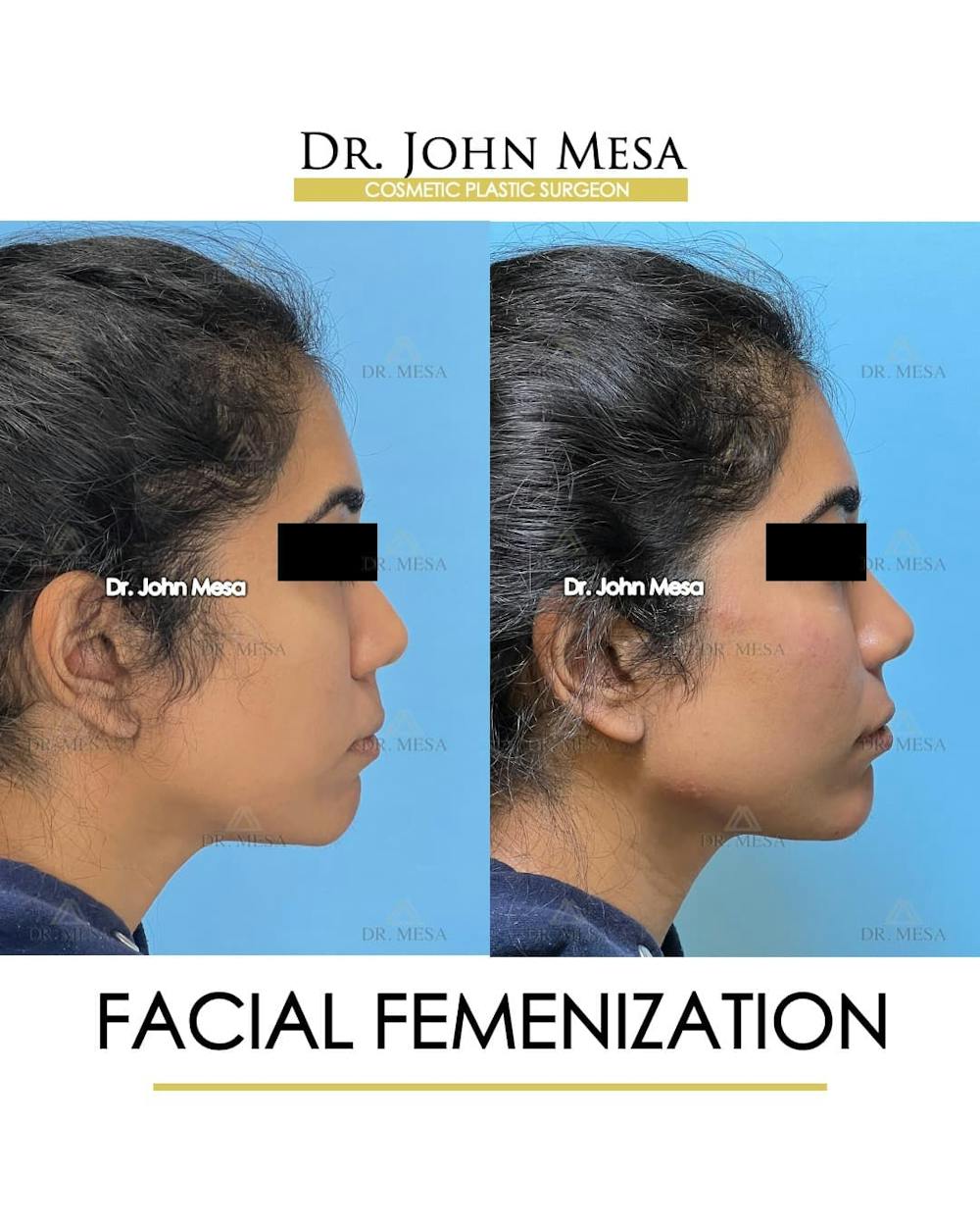 Facial Feminization Before & After Gallery - Patient 842309 - Image 4