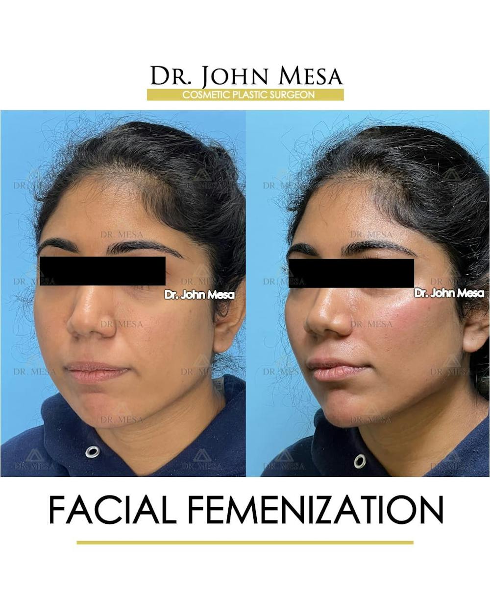 Facial Feminization Before & After Gallery - Patient 842309 - Image 5