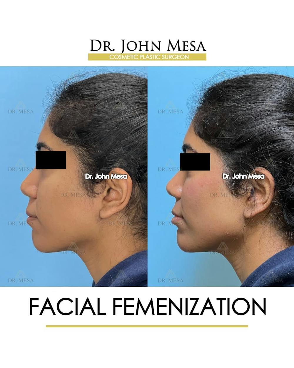 Facial Feminization Before & After Gallery - Patient 842309 - Image 6