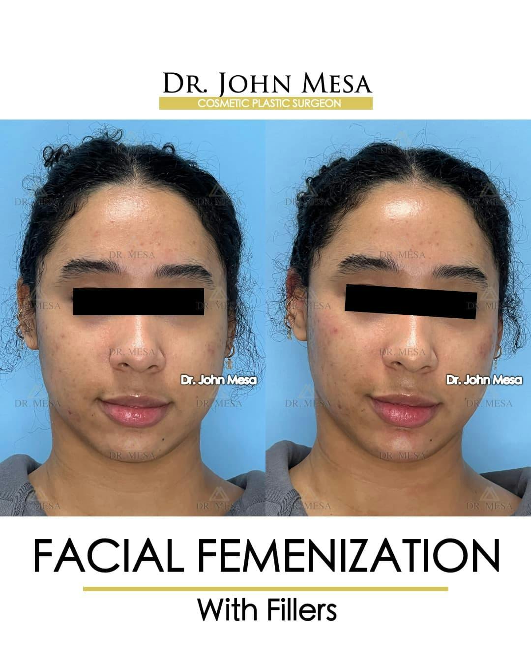 Facial Feminization Before & After Gallery - Patient 199096 - Image 1