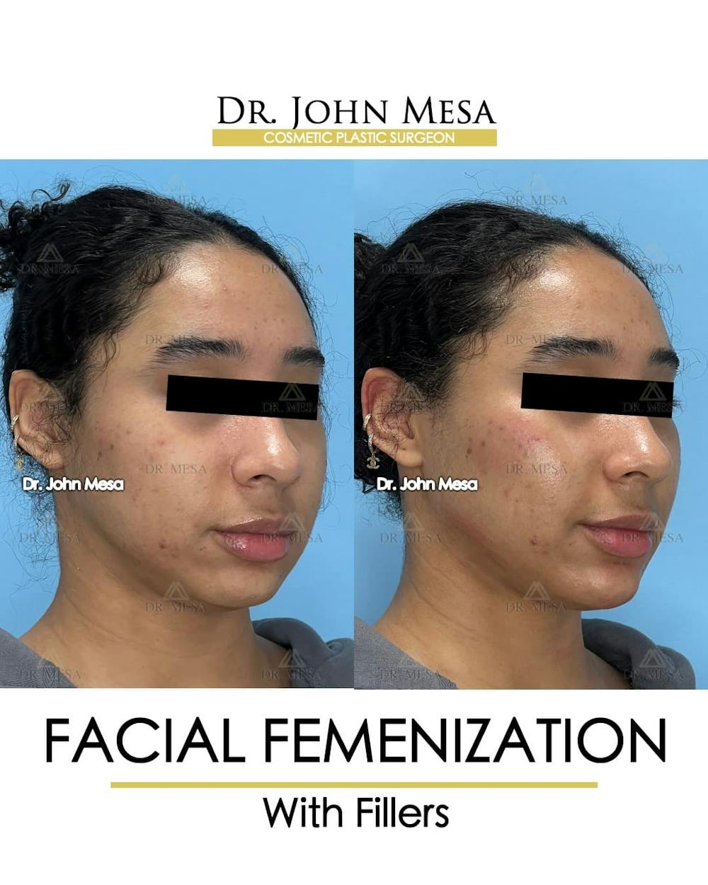 Facial Feminization Before & After Gallery - Patient 199096 - Image 2