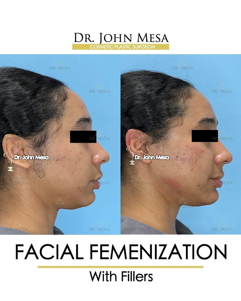 Facial Feminization Before & After Gallery - Patient 199096 - Image 3