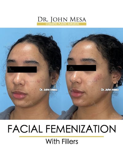 Facial Feminization Before & After Gallery - Patient 199096 - Image 4