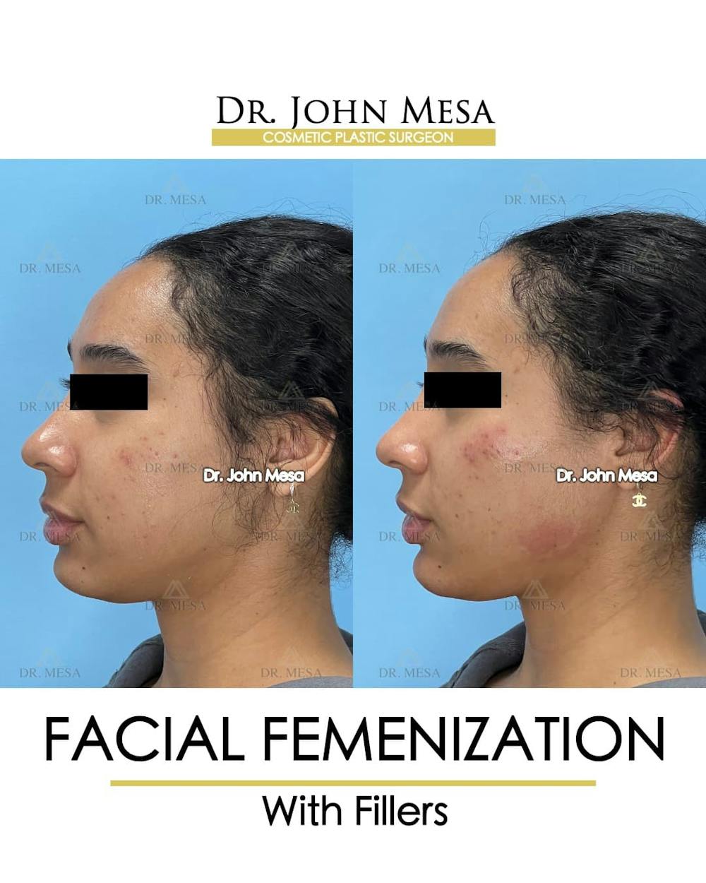 Facial Feminization Before & After Gallery - Patient 199096 - Image 5