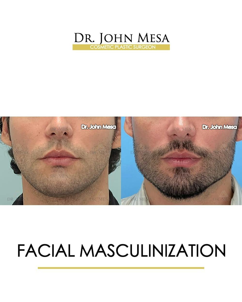Facial Masculinization Before & After Gallery - Patient 166654 - Image 1
