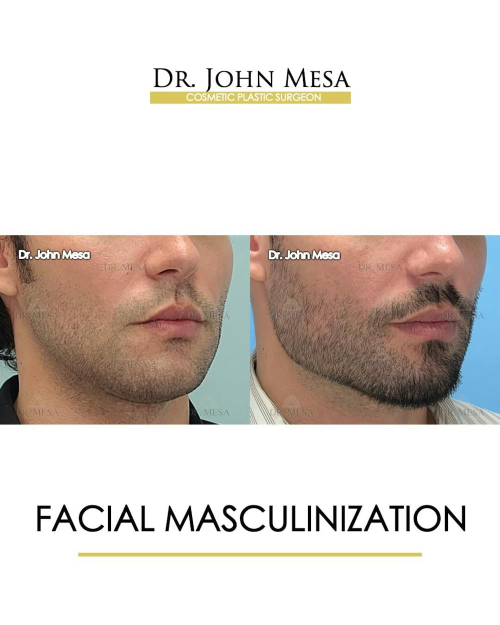 Facial Masculinization Before & After Gallery - Patient 166654 - Image 2