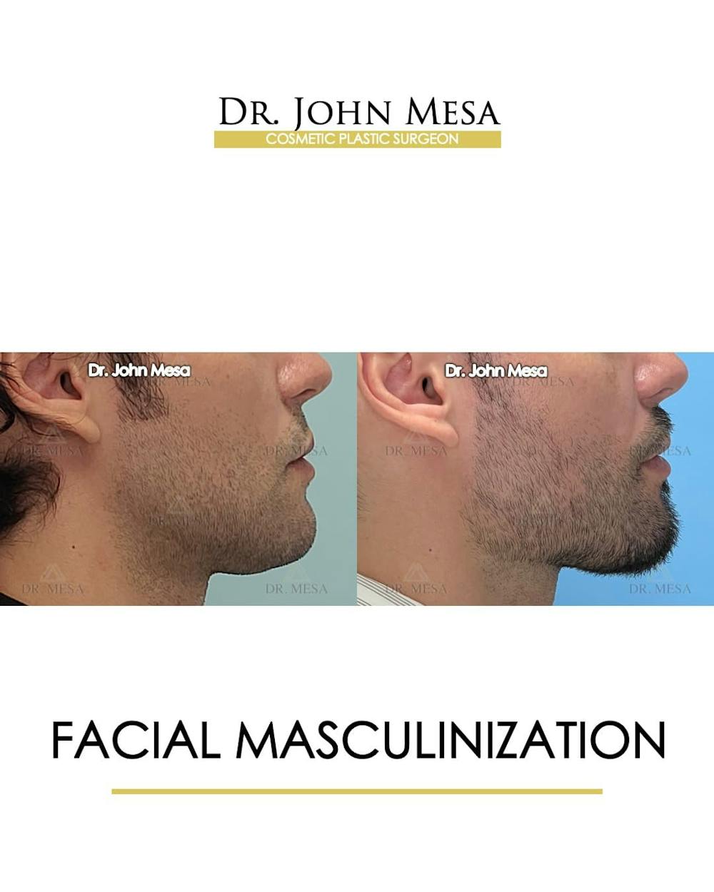Facial Masculinization Before & After Gallery - Patient 166654 - Image 3