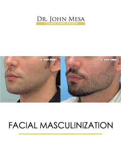 Facial Masculinization Before & After Gallery - Patient 166654 - Image 4