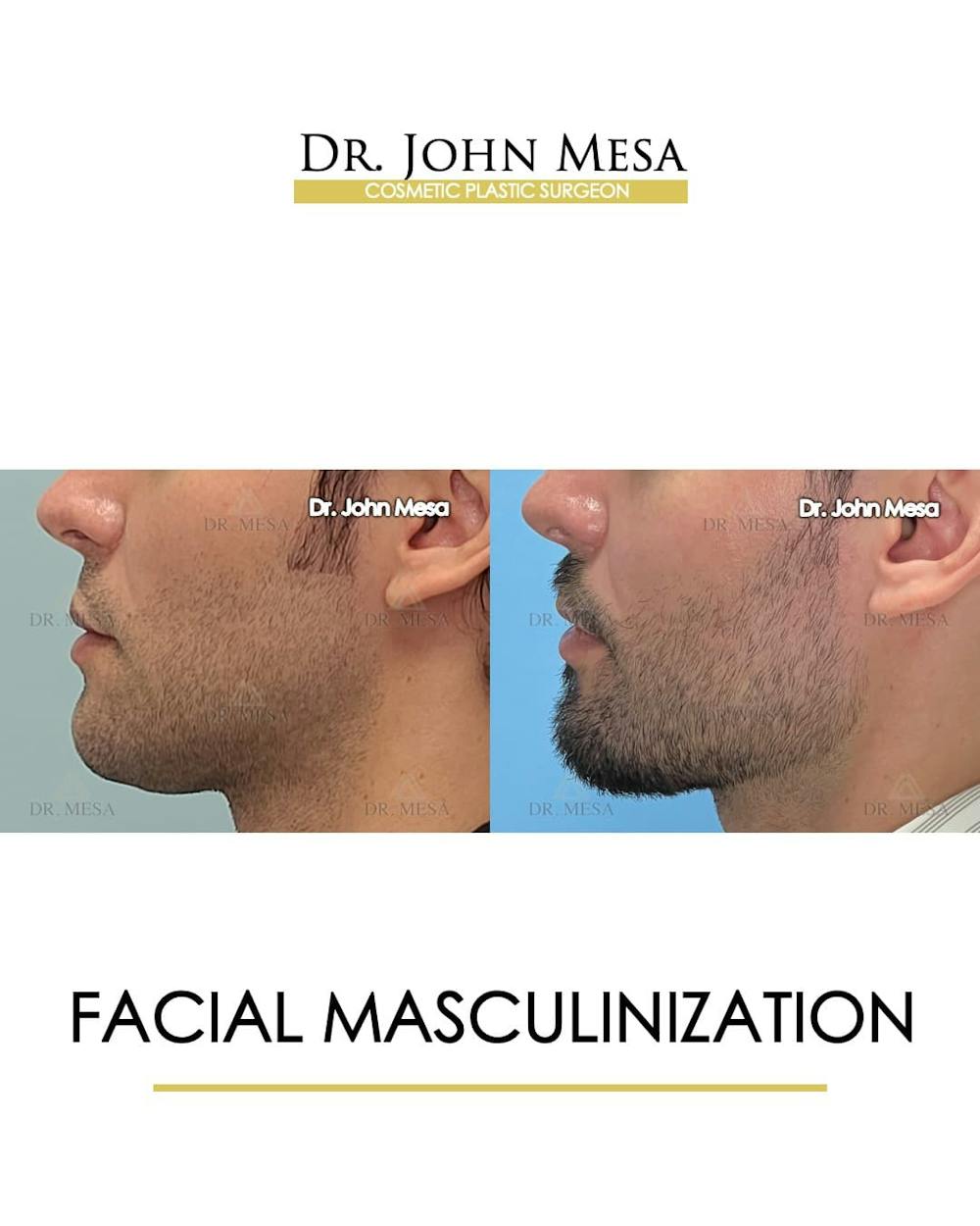 Facial Masculinization Before & After Gallery - Patient 166654 - Image 5