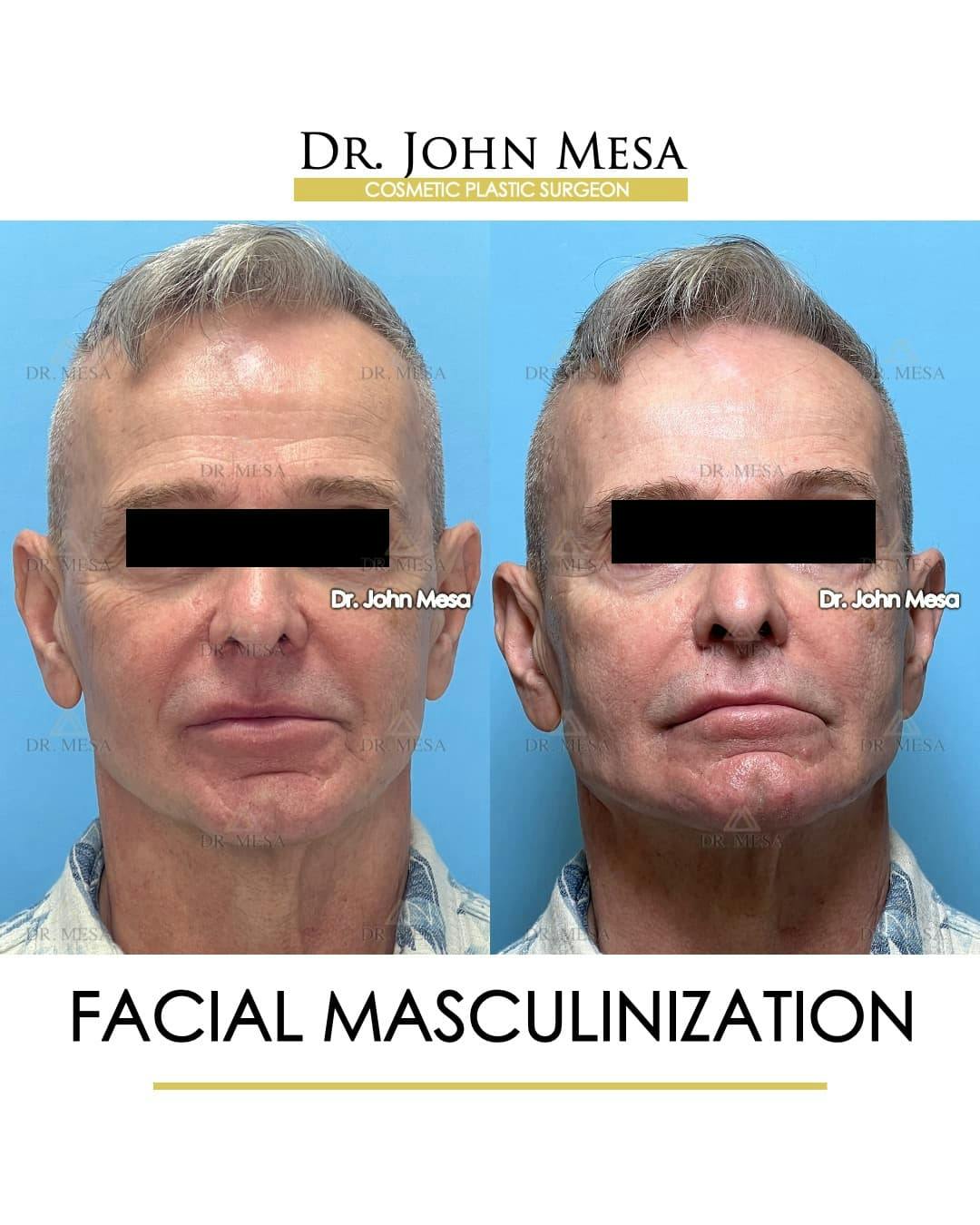Facial Masculinization Before & After Photos Dr. Mesa