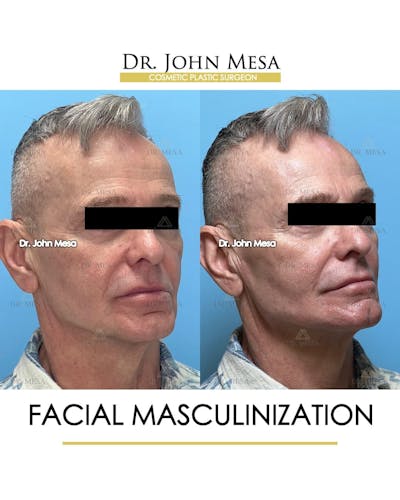 Facial Masculinization Before & After Gallery - Patient 242373 - Image 2