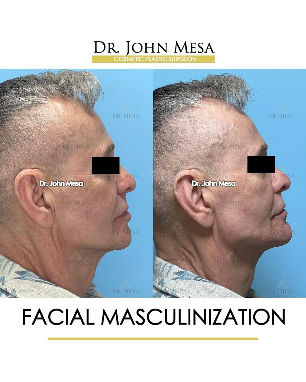 Facial Masculinization Before & After Gallery - Patient 242373 - Image 3