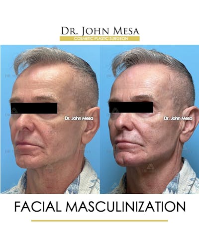 Facial Masculinization Before & After Gallery - Patient 242373 - Image 4