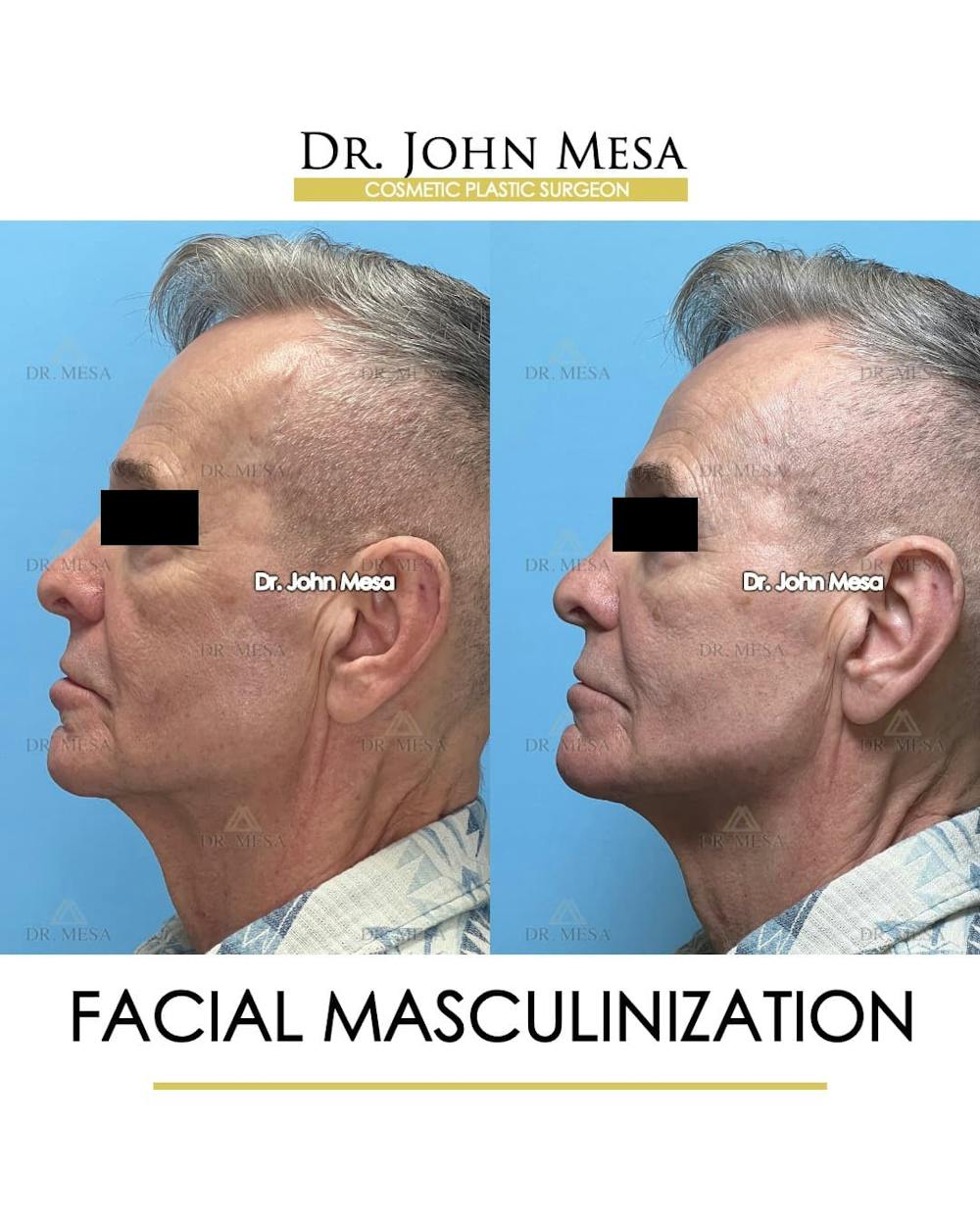 Facial Masculinization Before & After Gallery - Patient 242373 - Image 5
