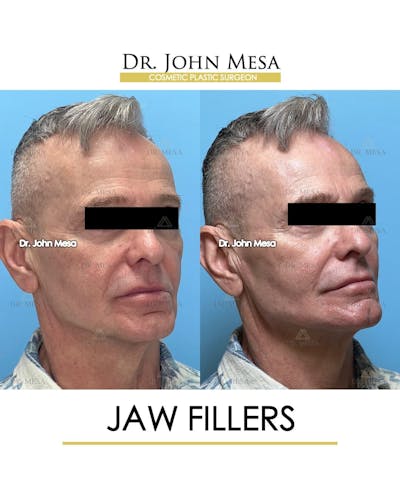 Jaw Filler Before & After Gallery - Patient 222541 - Image 2