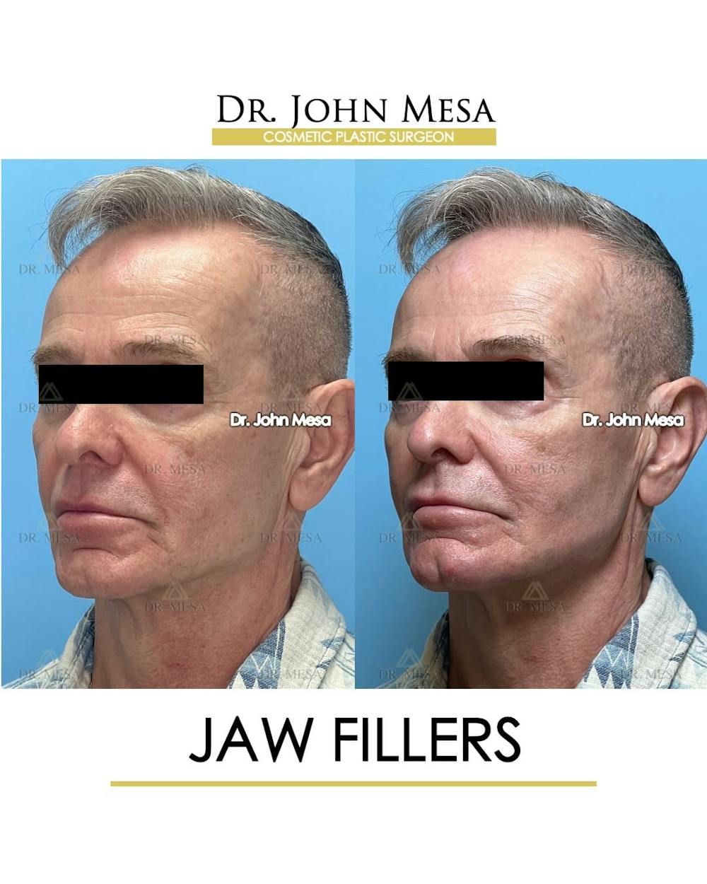 Jaw Filler Before & After Gallery - Patient 222541 - Image 4