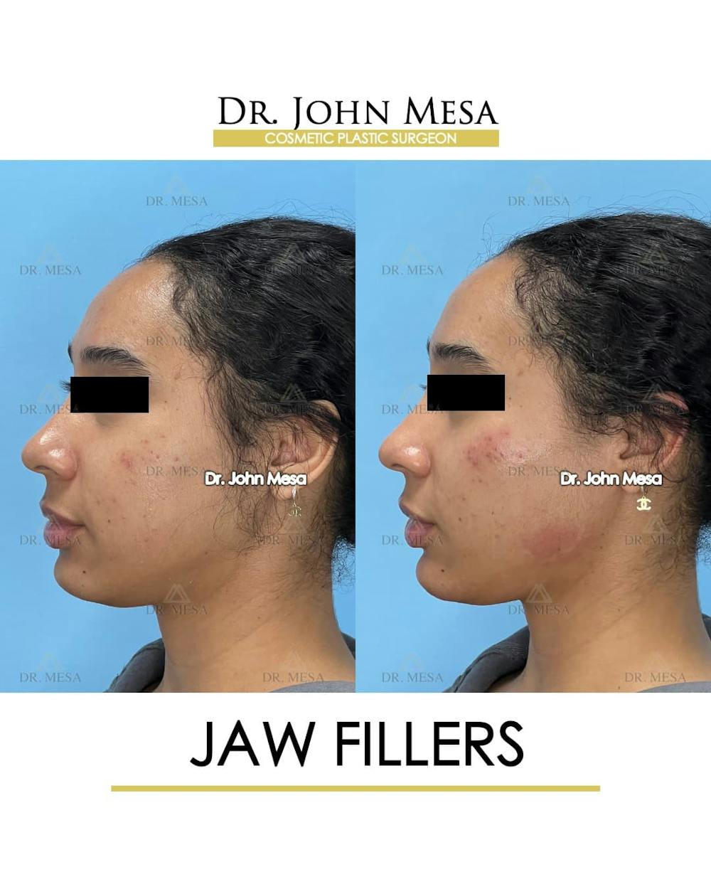 Jaw Filler Before & After Gallery - Patient 208857 - Image 5