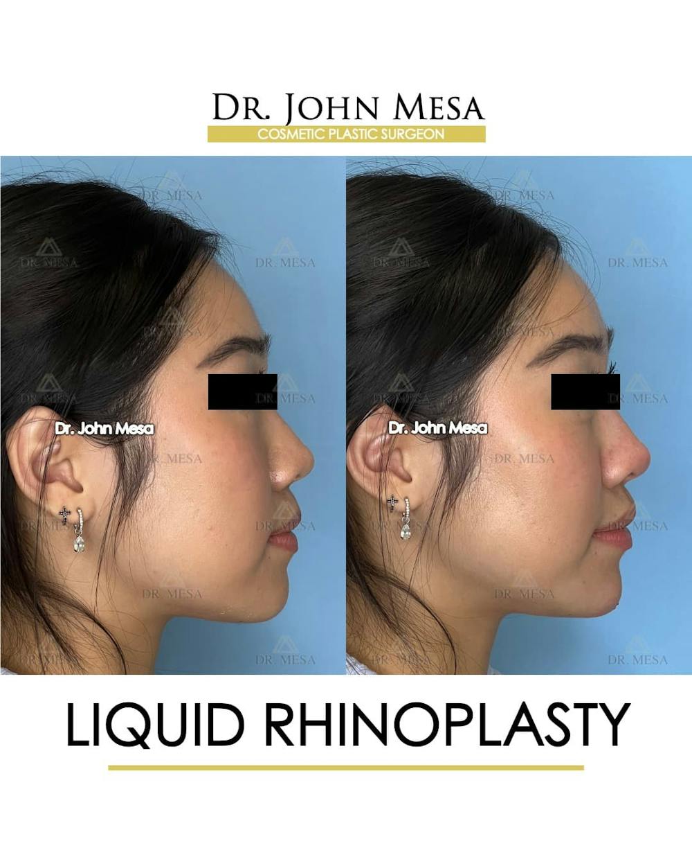 Liquid Rhinoplasty Before & After Gallery - Patient 133764 - Image 2