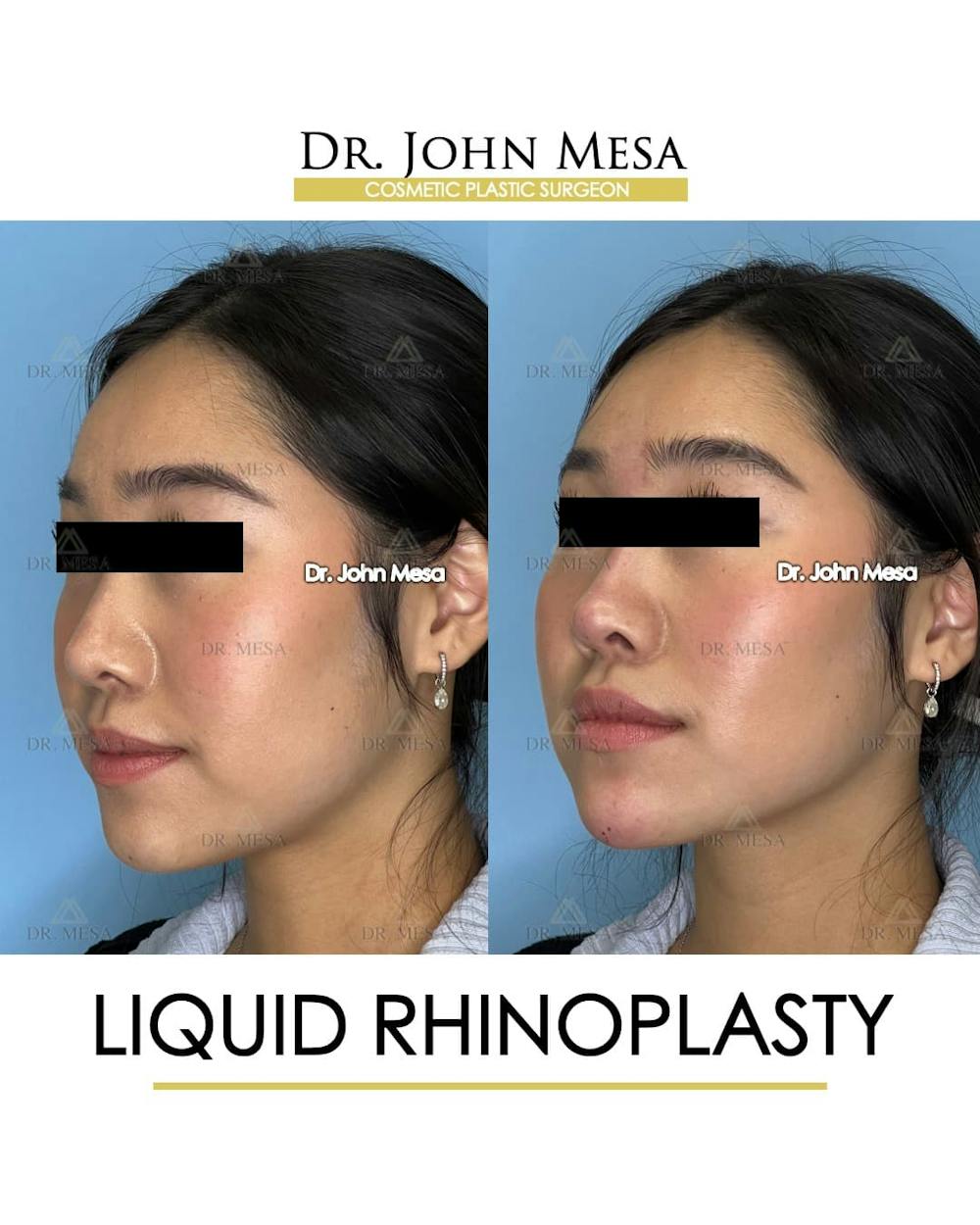 Liquid Rhinoplasty Before & After Gallery - Patient 133764 - Image 3