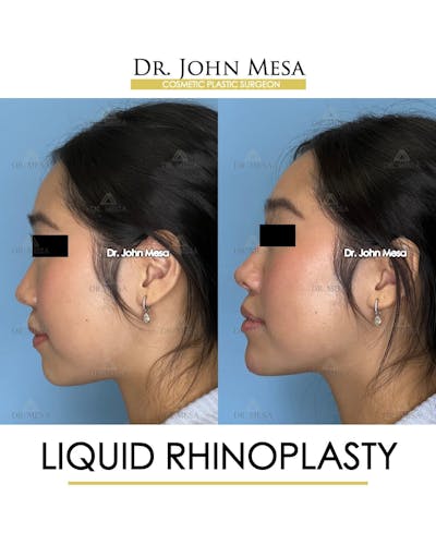 Liquid Rhinoplasty Before & After Gallery - Patient 133764 - Image 4