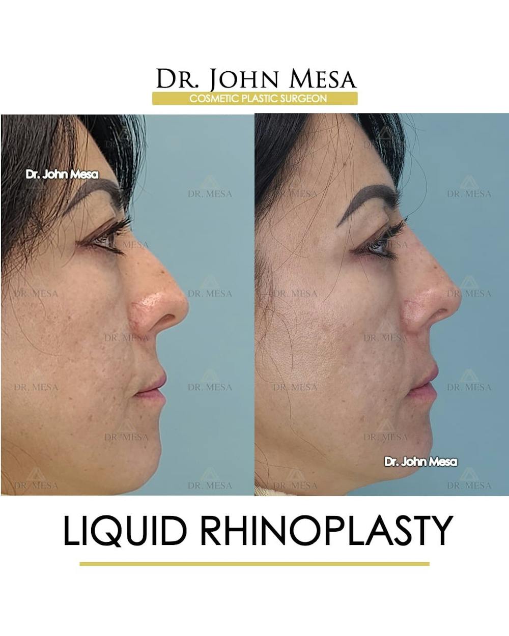 Liquid Rhinoplasty Before & After Gallery - Patient 283384 - Image 2