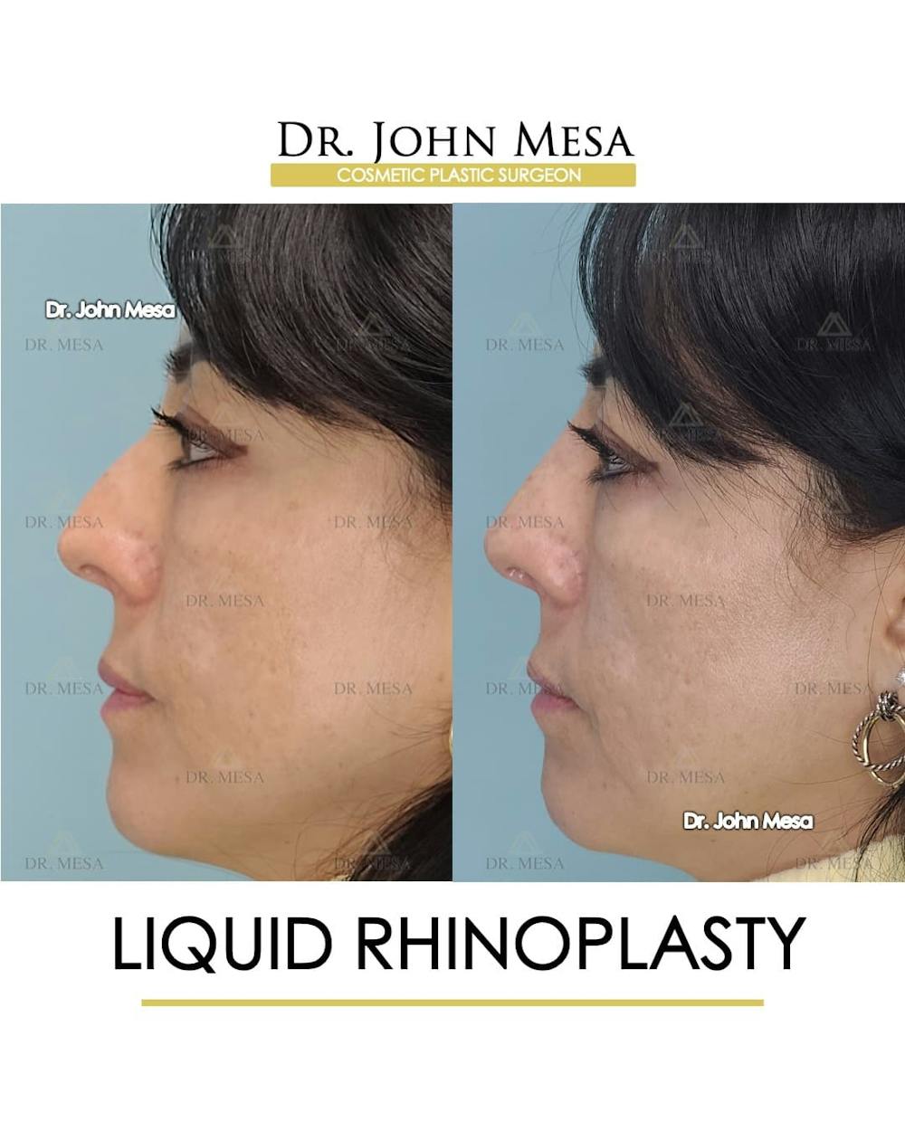 Liquid Rhinoplasty Before & After Gallery - Patient 283384 - Image 3