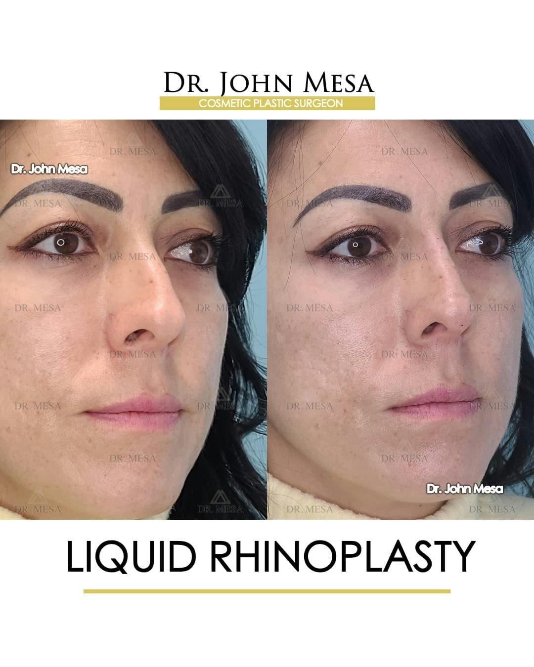 Liquid Rhinoplasty Before & After Gallery - Patient 283384 - Image 1