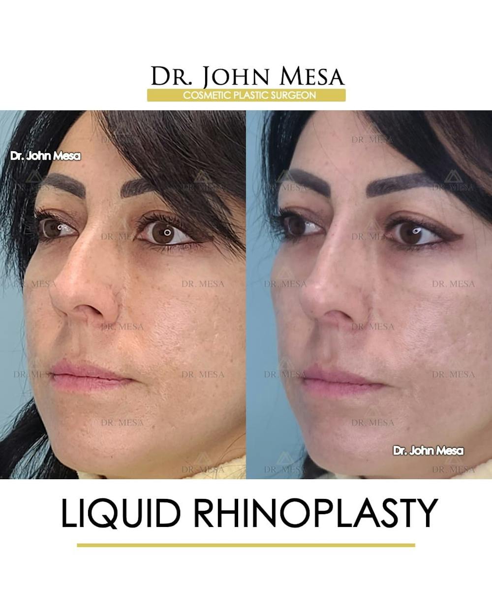 Liquid Rhinoplasty Before & After Gallery - Patient 283384 - Image 4