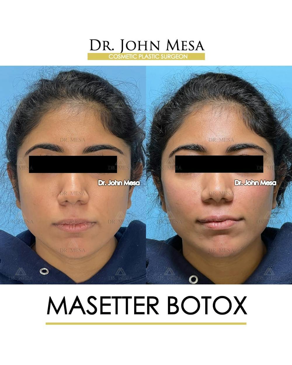 BOTOX Before & After Gallery - Patient 185252 - Image 1