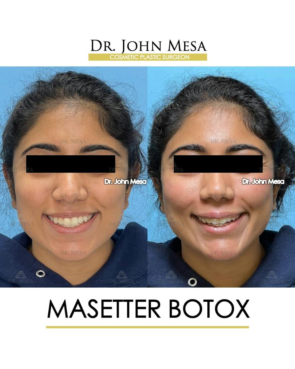 BOTOX Before & After Gallery - Patient 185252 - Image 2